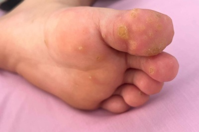 không chủ quan với mụn cóc lòng bàn tay, bàn chân.